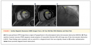 図１　左（A） Early MVO   右（B） Late MVO　　 文献[4]　より引用